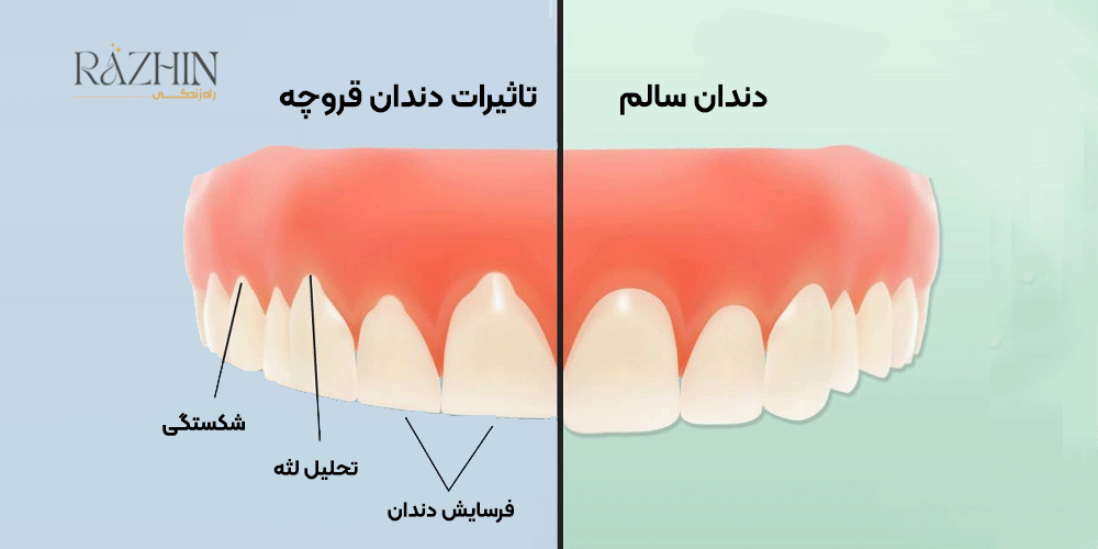 درمان دندان قروچه
