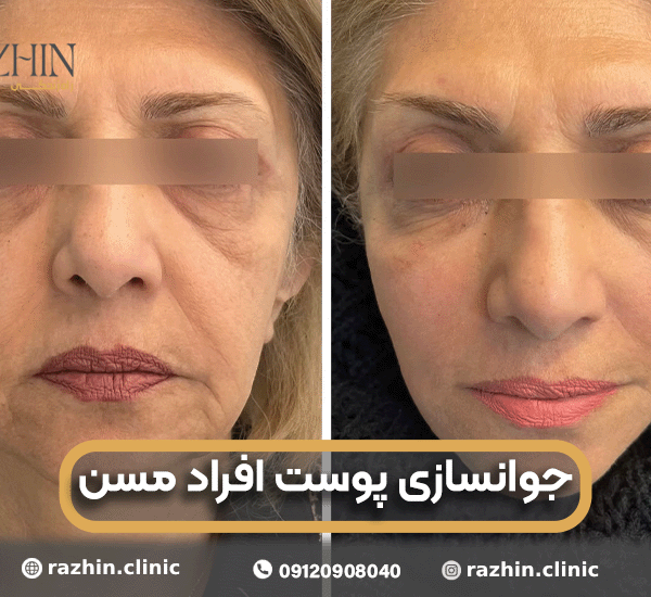 جوانسازی پوست افراد مسن