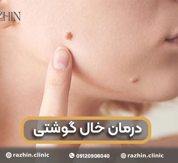 درمان خال گوشتی در کلینیک راژین