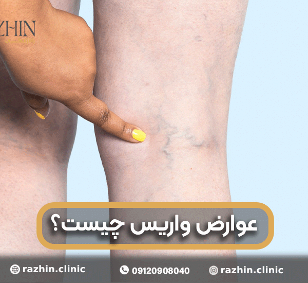 عوارض واریس چیست