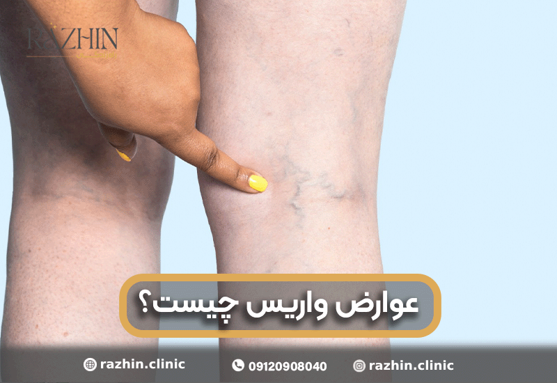 عوارض واریس چیست