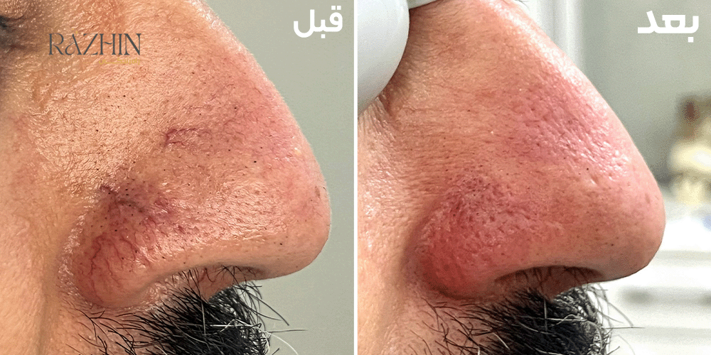 عوارض واریس چیست