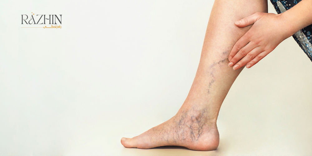 اسکلروتراپی