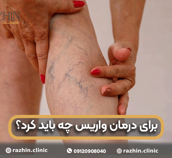 برای درمان واریس چه باید کرد
