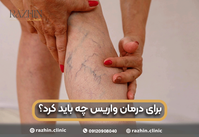 برای درمان واریس چه باید کرد
