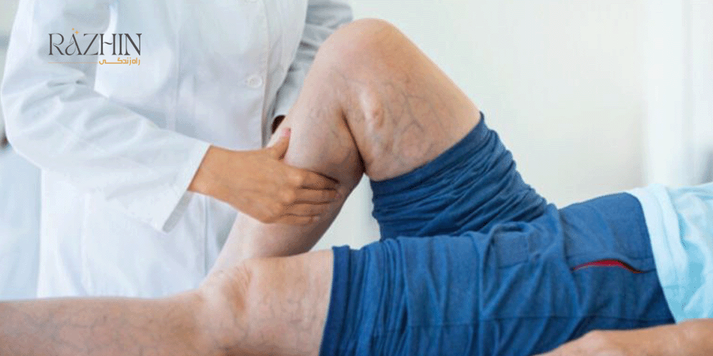 برای درمان واریس چه باید انجام داد