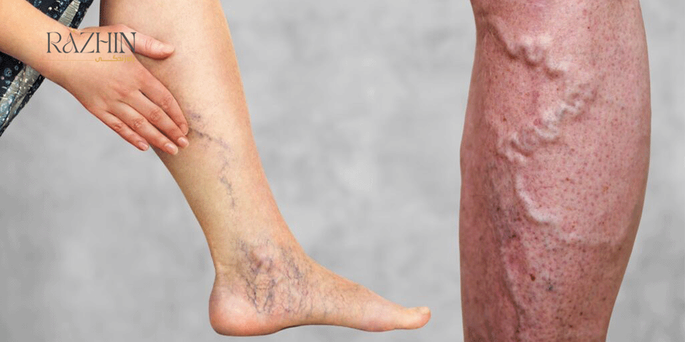 تفاوت رگ عنکبوتی با رگ واریسی