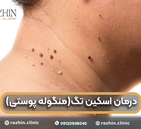 درمان اسکین تگ