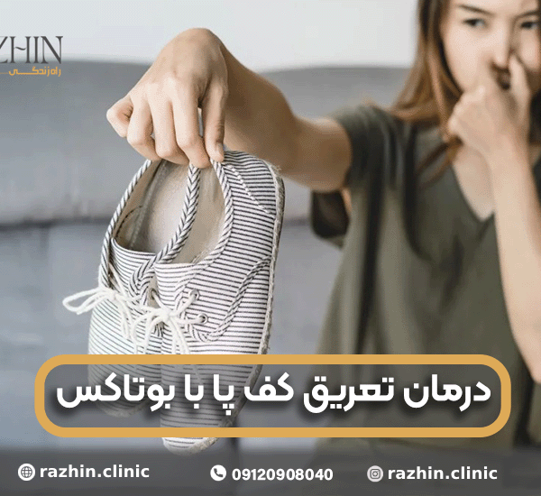 درمان تعریق کف پا با بوتاکس