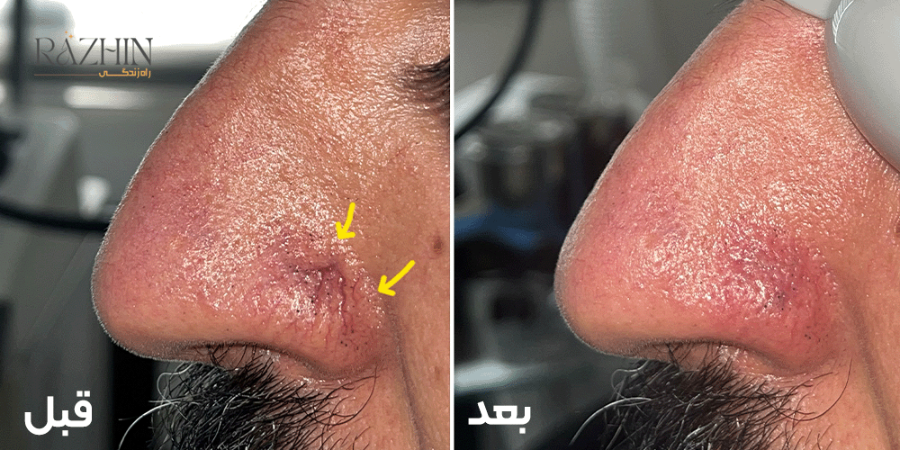 درمان واریس بینی