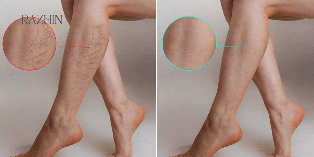 درمان واریس