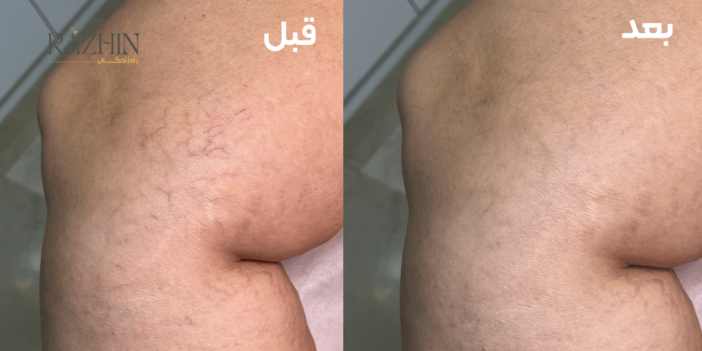 قبل و بعد درمان واریس پا