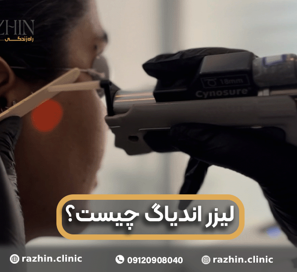 لیزر اندیاگ چیست