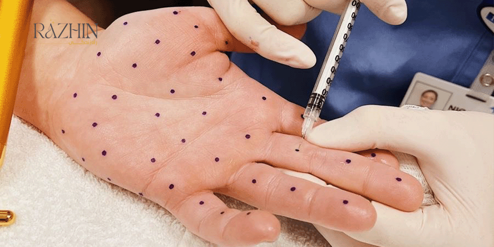 مراقبت ها بعد از بوتاکس تعریق