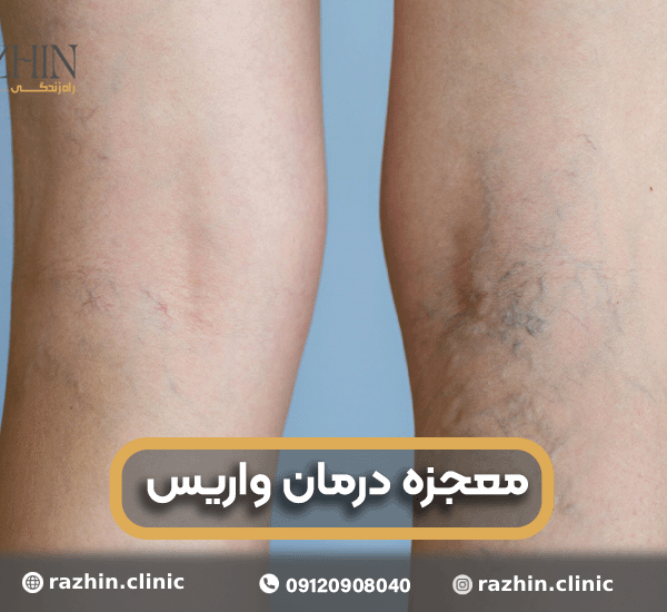 معجزه درمان واریس در کلینیک راژین
