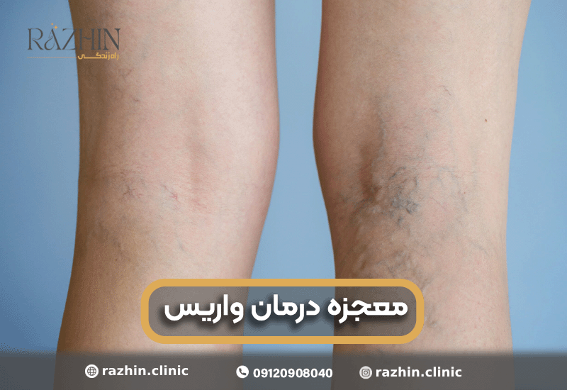 معجزه درمان واریس در کلینیک راژین
