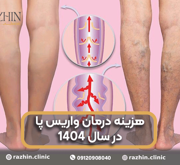 هزینه درمان واریس پا