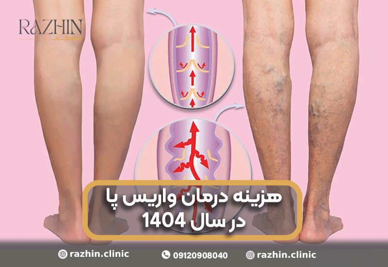 هزینه درمان واریس پا