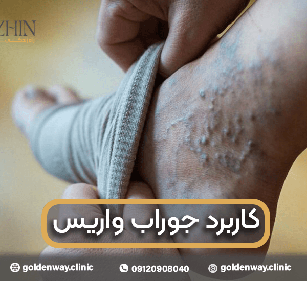 کاربرد جوراب واریس