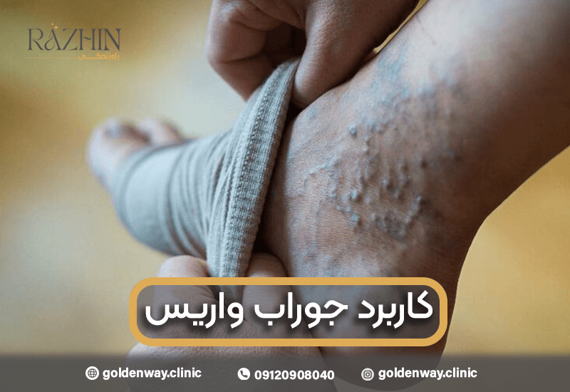 کاربرد جوراب واریس