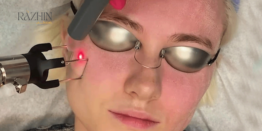 درمان جای جوش با لیزر CO۲ فرکشنال