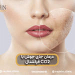 درمان جای جوش با لیزر CO۲ فرکشنال