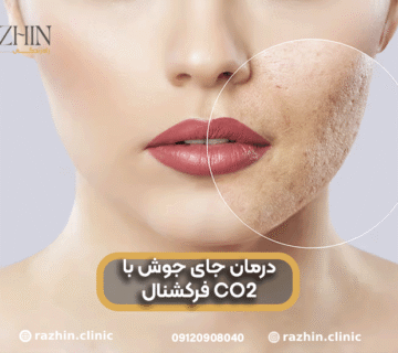 درمان جای جوش با لیزر CO۲ فرکشنال