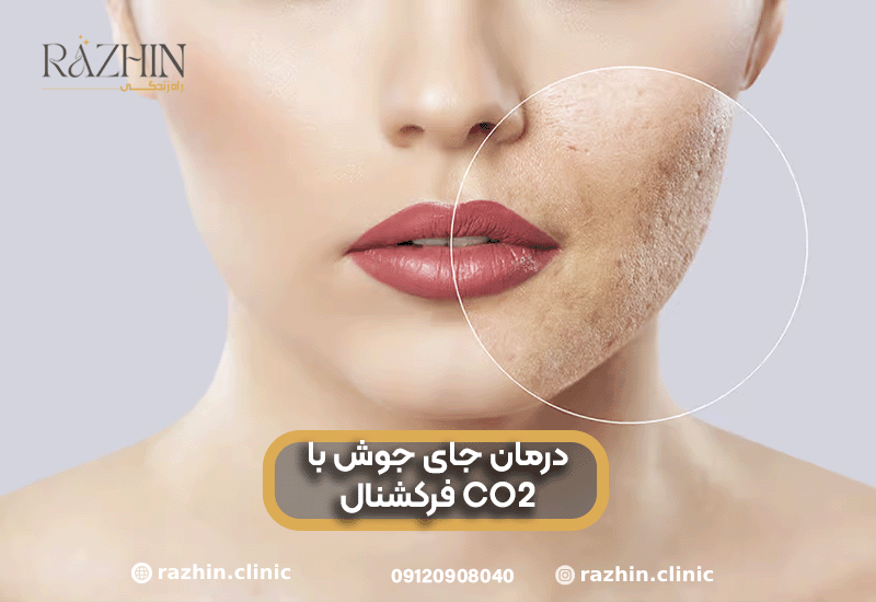 درمان جای جوش با لیزر CO۲ فرکشنال