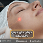 درمان جای جوش با اندولیفت