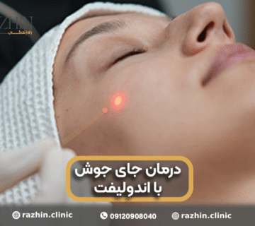 درمان جای جوش با اندولیفت
