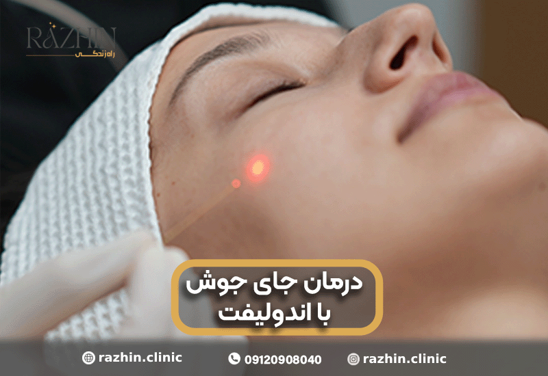 درمان جای جوش با اندولیفت