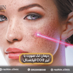 درمان لک صورت با لیزر CO2 فرکشنال
