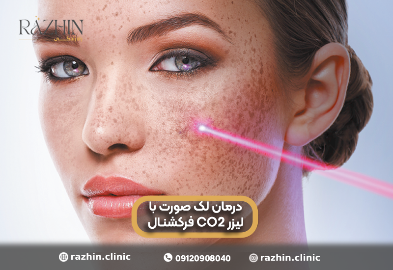 درمان لک صورت با لیزر CO2 فرکشنال