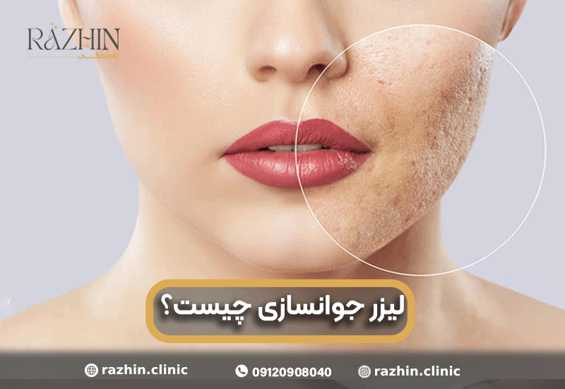 لیزر جوانسازی