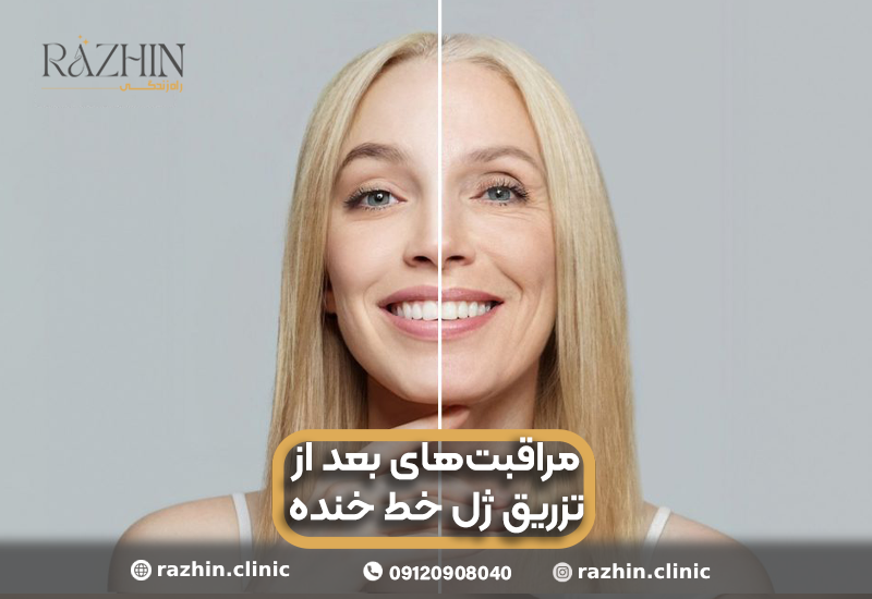 مراقبت های بعد از تزریق ژل خط خنده