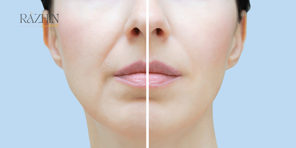 تزریق ژل خط خنده