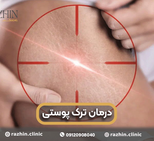 درمان ترک پوستی