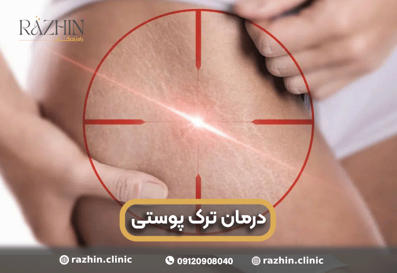 درمان ترک پوستی