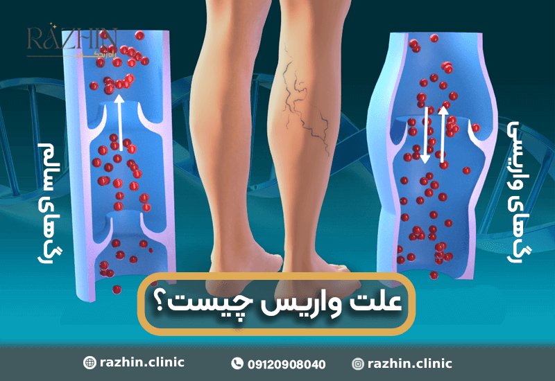 علت واریس پا