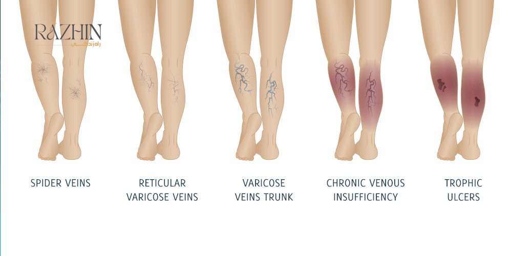 انواع واریس پا