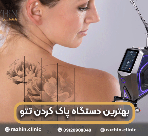 بهترین دستگاه پاک کردن تتو