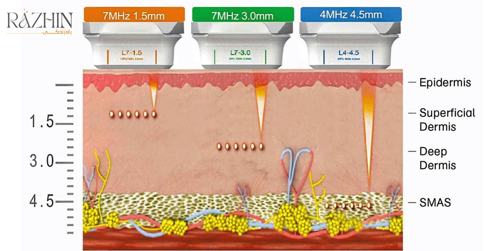 خرید دستگاه هایفو