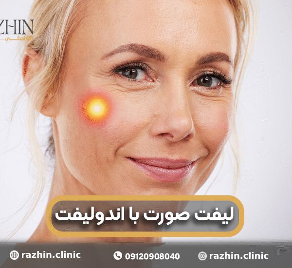 لیفت صورت با لیزر اندولیفت