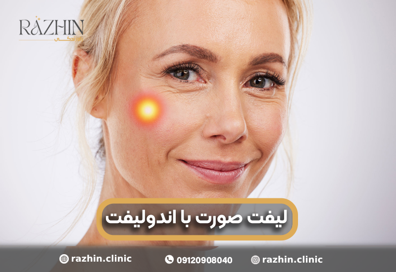 لیفت صورت با لیزر اندولیفت