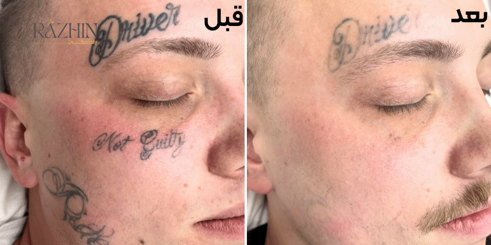 پاک کردن تتو با لیزر کیوسوئیچ