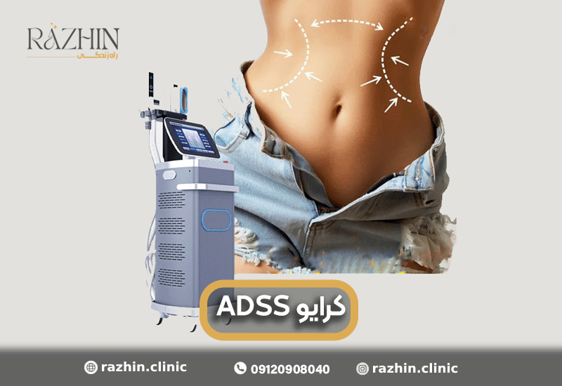 دستگاه کرایو ADSS