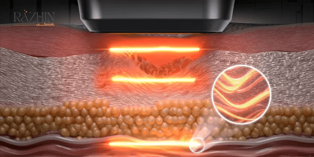 هایفو 22 بعدی