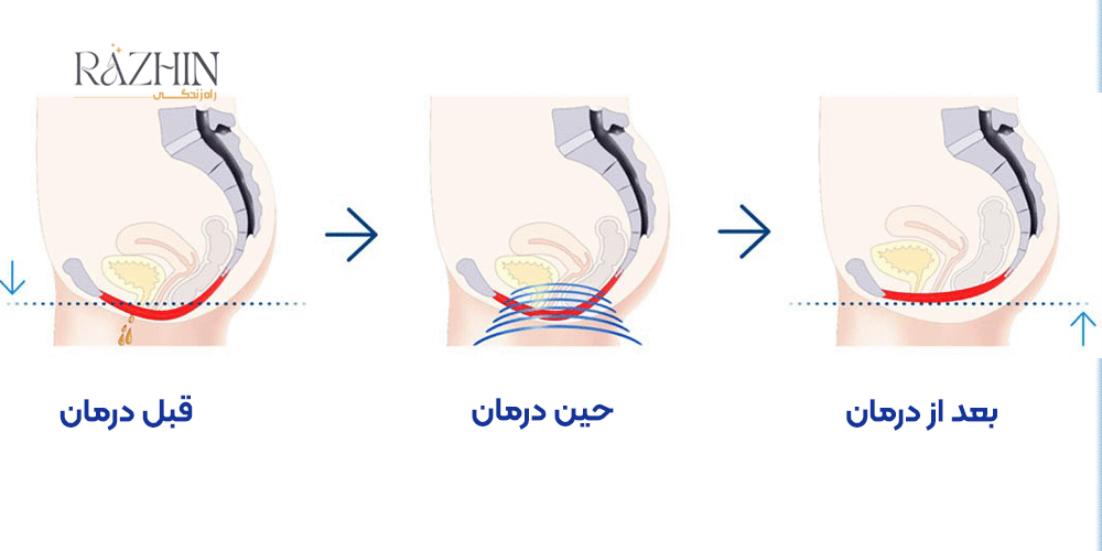 صندلی بی اختیاری ادرار