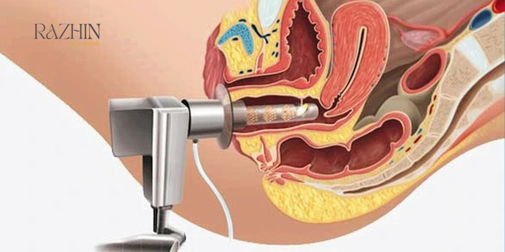 آر اف واژینال