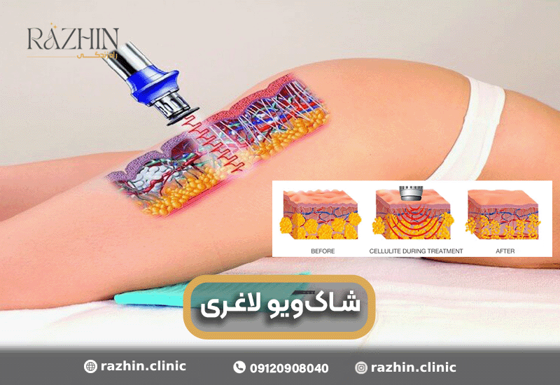 شاک ویو لاغری